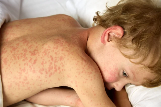 Measles outbreak spreads through UK