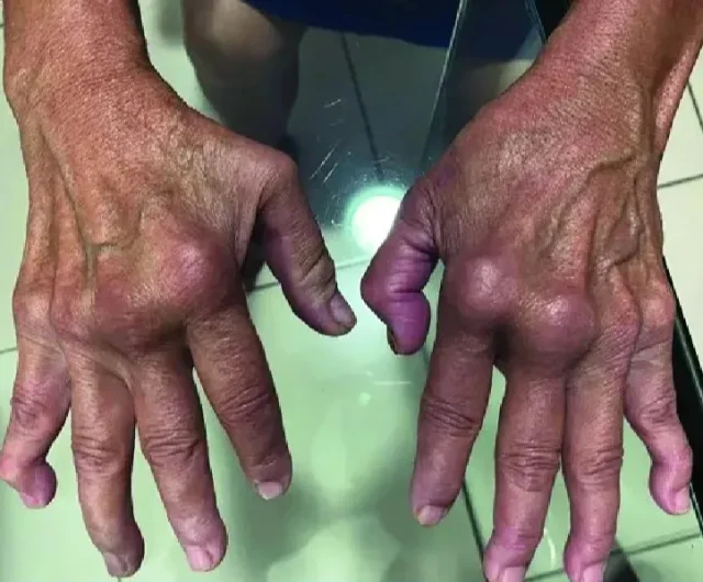 Cases of tropical k!ller virus that makes body ‘fold in on itself’ soar 43% in UK