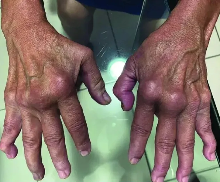 Cases of tropical k!ller virus that makes body ‘fold in on itself’ soar 43% in UK