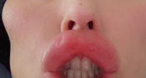 Woman with ‘UK’s biggest lips’ has lip fillers dissolved to show natural look Woman with 'UK's biggest lips' has lip fillers dissolved to show natural look