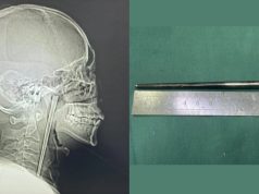 Drunkard spent 8 years with metal chopstick stuck in his throat Drunkard spent 8 years with metal chopstick stuck in his throat