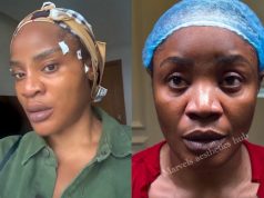 Uche Ogbodo shows off face first day after surgery Uche Ogbodo shows off face first day after surgery