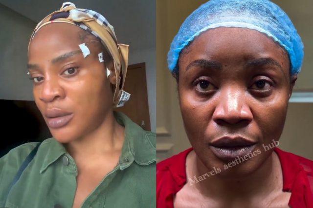 Uche Ogbodo shows off face first day after surgery