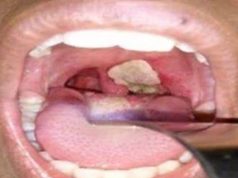 Diphtheria claims 23 lives in Plateau Diphtheria claims 23 lives in Plateau
