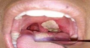 Diphtheria claims 23 lives in Plateau Diphtheria claims 23 lives in Plateau