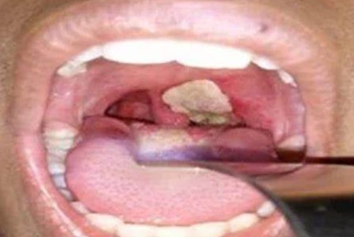 Diphtheria claims 23 lives in Plateau Diphtheria claims 23 lives in Plateau